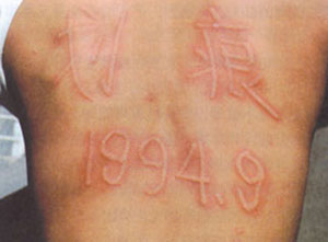 荨麻疹